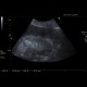 Acute nephritis: US - Ultrasound