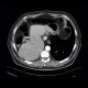 Adenocarcinoma of gallbladder, fistula to colon: CT - Computed tomography