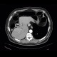 Adenocarcinoma of gallbladder, fistula to colon: CT - Computed tomography