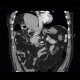 Adenocarcinoma of gallbladder, fistula to colon: CT - Computed tomography