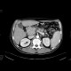 Adenocarcinoma of biliary duct: CT - Computed tomography