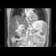 Adenocarcinoma of biliary duct: MRI - Magnetic Resonance Imaging