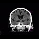 Adenoma of hypophysis: CT - Computed tomography