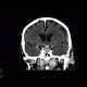 Adenoma of hypophysis: CT - Computed tomography