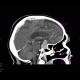 Adenoma of hypophysis: CT - Computed tomography