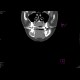 Adenoma of parathyroid gland, brown tumours: CT - Computed tomography