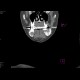 Adenoma of parathyroid gland, brown tumours: CT - Computed tomography