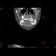 Adenoma of parathyroid gland, brown tumours: CT - Computed tomography