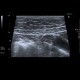 Adenomyosis of gallbladder, localized: US - Ultrasound