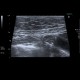 Adenomyosis of gallbladder, localized: US - Ultrasound