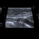 Adenomyosis of gallbladder, localized: US - Ultrasound