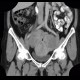 Mixed adenoneuroendocrine tumour of appendix, mixed tumour, hydronephrosis, ascites: CT - Computed tomography