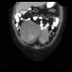 Mixed adenoneuroendocrine tumour of appendix, mixed tumour, hydronephrosis, ascites: CT - Computed tomography