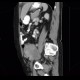 Mixed adenoneuroendocrine tumour of appendix, mixed tumour, hydronephrosis, ascites: CT - Computed tomography