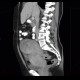 Mixed adenoneuroendocrine tumour of appendix, mixed tumour, hydronephrosis, ascites: CT - Computed tomography