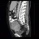 Mixed adenoneuroendocrine tumour of appendix, mixed tumour, hydronephrosis, ascites: CT - Computed tomography