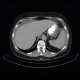 Mixed adenoneuroendocrine tumour of appendix, mixed tumour, hydronephrosis, ascites: CT - Computed tomography