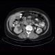 Mixed adenoneuroendocrine tumour of appendix, mixed tumour, hydronephrosis, ascites: CT - Computed tomography