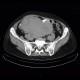 Mixed adenoneuroendocrine tumour of appendix, mixed tumour, hydronephrosis, ascites: CT - Computed tomography