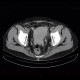 Mixed adenoneuroendocrine tumour of appendix, mixed tumour, hydronephrosis, ascites: CT - Computed tomography