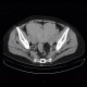 Mixed adenoneuroendocrine tumour of appendix, mixed tumour, hydronephrosis, ascites: CT - Computed tomography