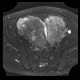 Mixed adenoneuroendocrine tumour of appendix, mixed tumour, hydronephrosis, ascites: MRI - Magnetic Resonance Imaging