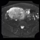 Mixed adenoneuroendocrine tumour of appendix, mixed tumour, hydronephrosis, ascites: MRI - Magnetic Resonance Imaging