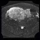 Mixed adenoneuroendocrine tumour of appendix, mixed tumour, hydronephrosis, ascites: MRI - Magnetic Resonance Imaging