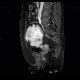 Mixed adenoneuroendocrine tumour of appendix, mixed tumour, hydronephrosis, ascites: MRI - Magnetic Resonance Imaging