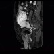 Mixed adenoneuroendocrine tumour of appendix, mixed tumour, hydronephrosis, ascites: MRI - Magnetic Resonance Imaging