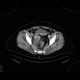 Sigmoid adenocarcinoma, peritoneal metastasis: CT - Computed tomography