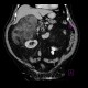 Adrenal myelolipoma: CT - Computed tomography