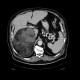 Adrenal myelolipoma: CT - Computed tomography