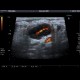 Inflammatory lymph node: US - Ultrasound