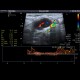 Inflammatory lymph node: US - Ultrasound