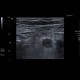Acute appendicitis: US - Ultrasound