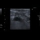 Acute appendicitis: US - Ultrasound