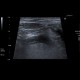 Acute appendicitis: US - Ultrasound