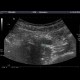 Acute appendicitis: US - Ultrasound