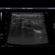 Acute appendicitis: US - Ultrasound