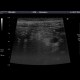 Acute appendicitis: US - Ultrasound