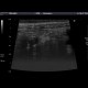 Acute appendicitis: US - Ultrasound