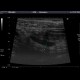 Acute appendicitis: US - Ultrasound