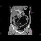 Acute appendicitis: CT - Computed tomography