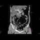 Acute appendicitis: CT - Computed tomography