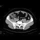 Acute appendicitis: CT - Computed tomography