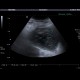 Acute cholecystitis, pericholecystitic abscess: US - Ultrasound