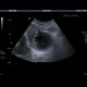 Acute cholecystitis, pericholecystitic abscess: US - Ultrasound