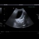 Acute cholecystitis, pericholecystitic abscess: US - Ultrasound