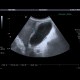 Acute cholecystitis, pericholecystitic abscess: US - Ultrasound